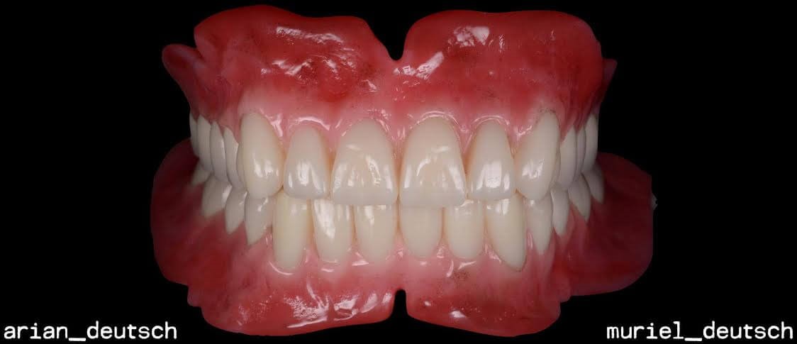 Wax Try In Dentures Wakeman OH 44889